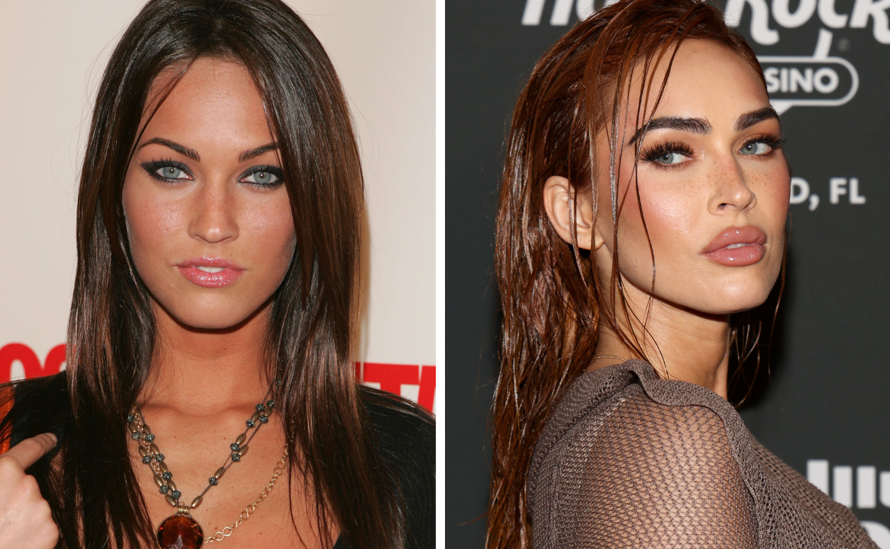 megan fox before after lip filler