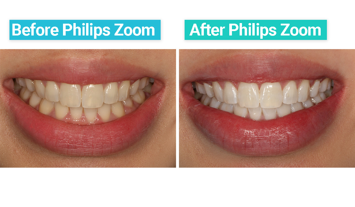 The Philips Zoom teeth whitening treatment put to the test