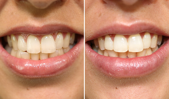 How-to: get whiter teeth in two days