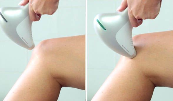 How-to: Use an IPL device