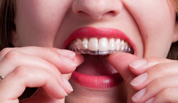 Cosmetic dental surgery: investigating Invisalign