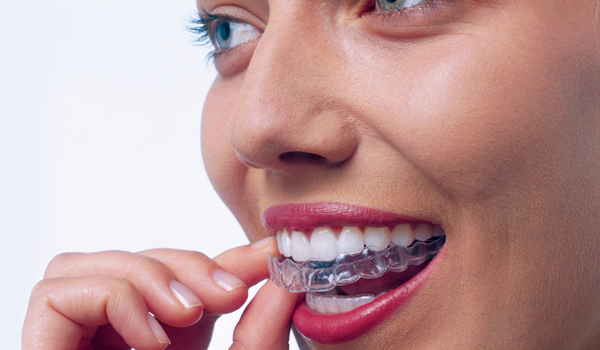 Reviewed: The Invisalign treatment