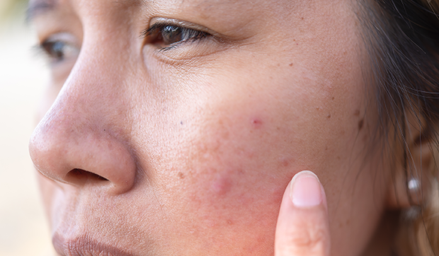 Broken capillaries: What are they doing on my face and how do I make them leave?