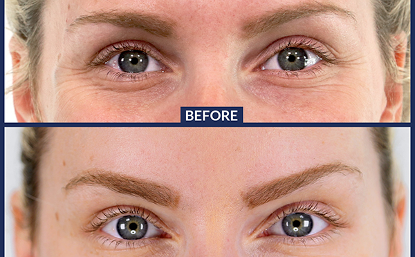 What is Botox: Before and After