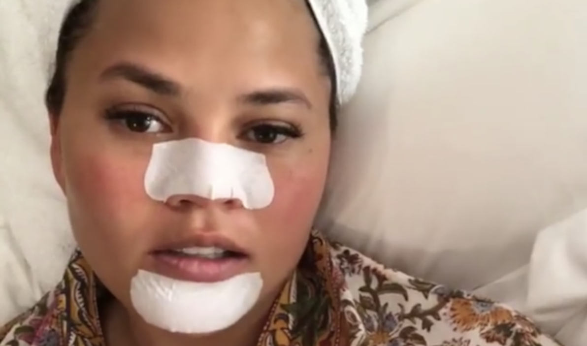 Chrissy Teigen shares her strange blackhead-removing routine