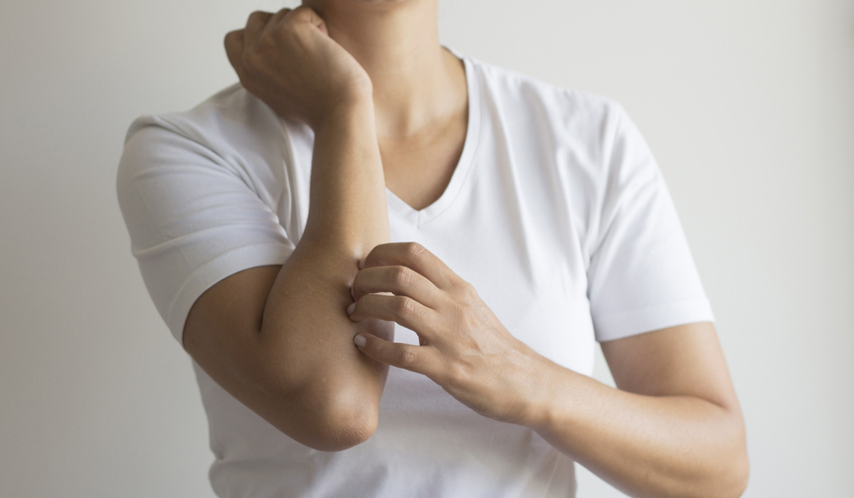 Dealing with eczema in winter beautyheaven