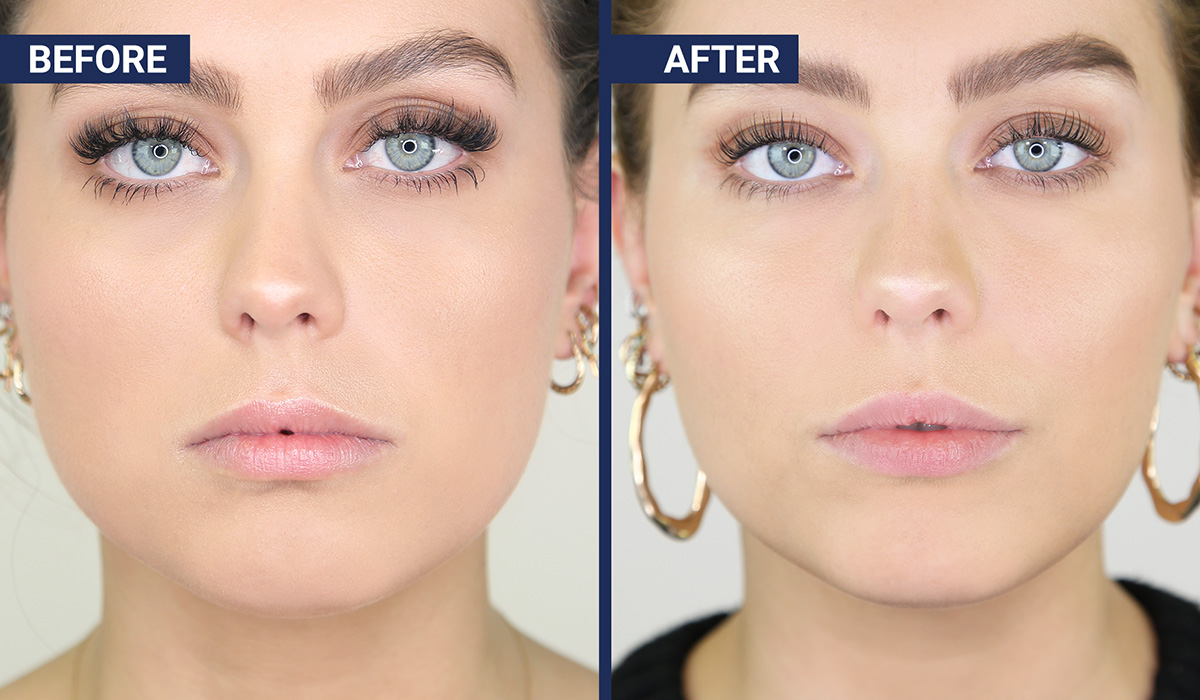 Before and after: Botox jaw injections to slim your face