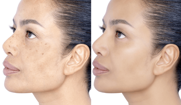 7 Ways To Effectively Prevent And Treat Hyperpigmentation