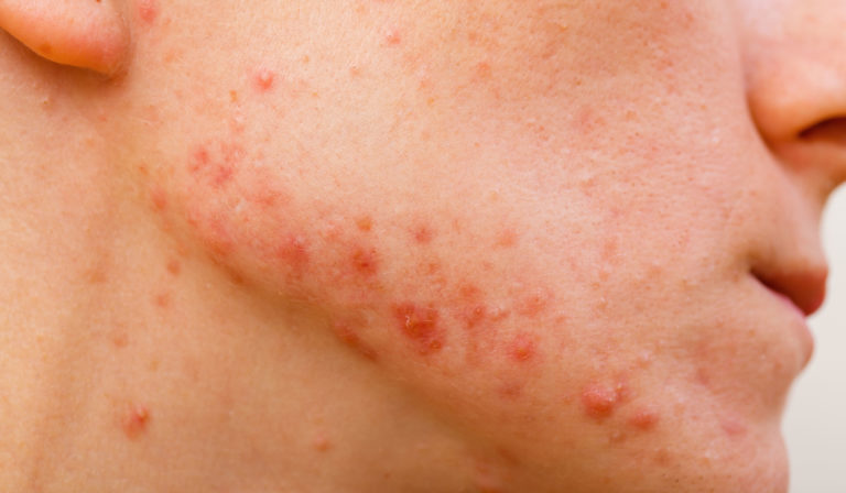 Different types of pimples, explained