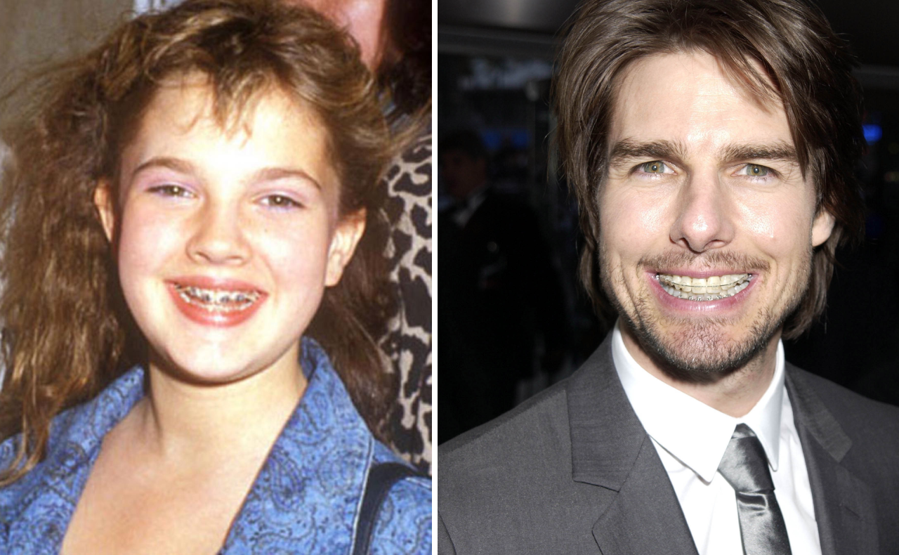 13 Celebrities Who Have Braces To Thank For Their Perfect Smiles
